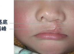 裂唇图片